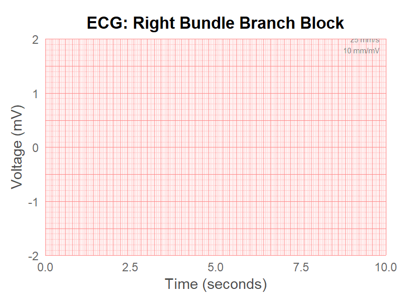 心電図:右脚ブロック